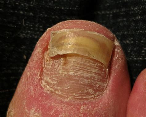 double layer toenail|double toenail on big toe.